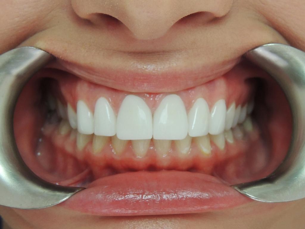 affordable dentures