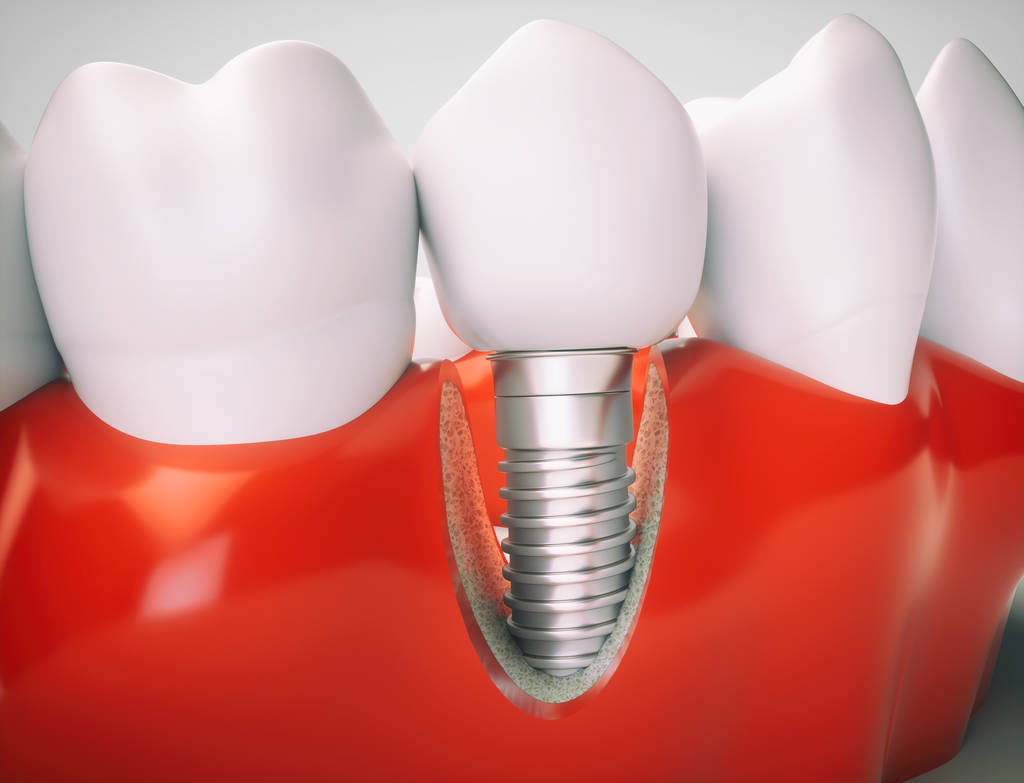 dental implants